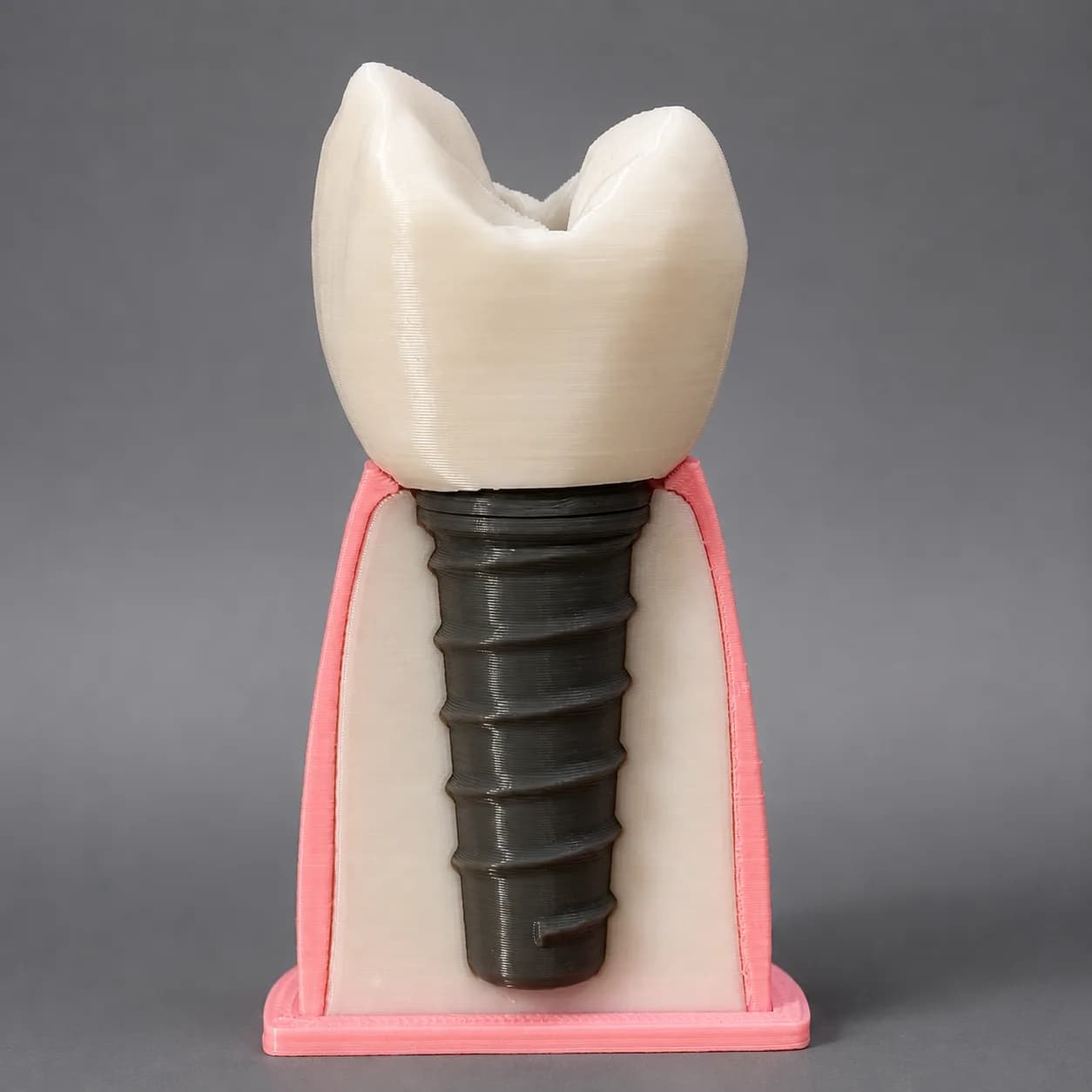 Dental Implant Demonstration Model 2